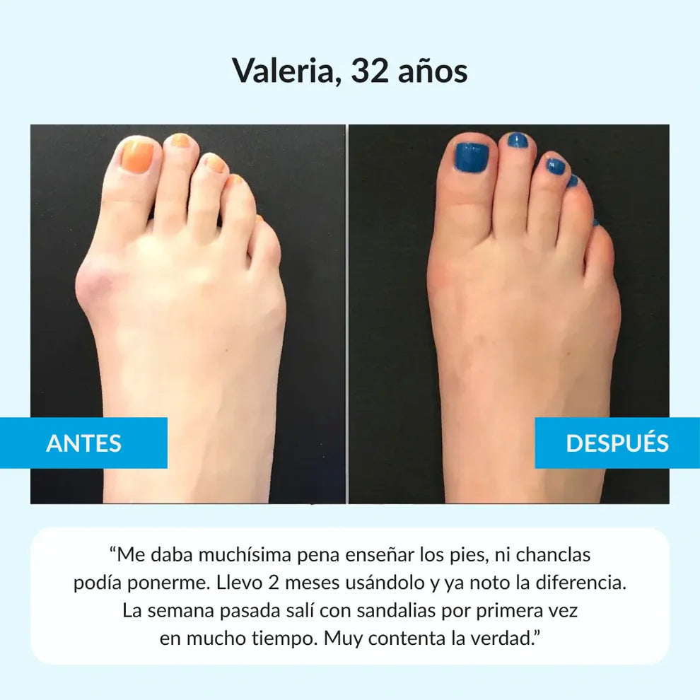 Orthomia™ - Corrector articular de juanetes