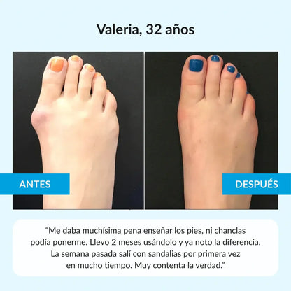 Orthomia™ - Corrector articular de juanetes