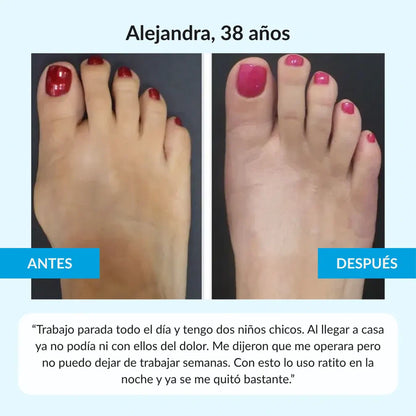 Orthomia™ - Corrector articular de juanetes